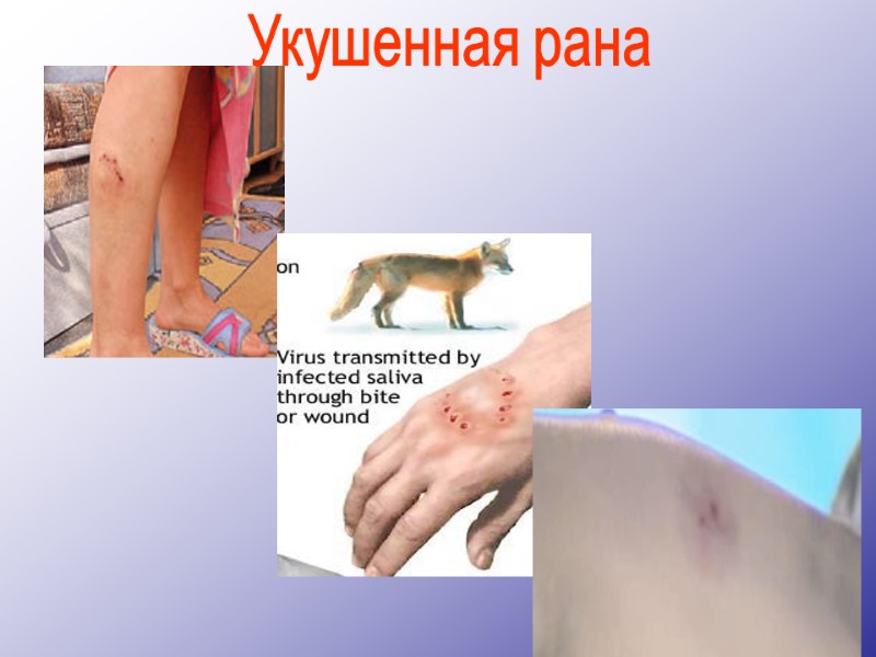 Укушенная рана